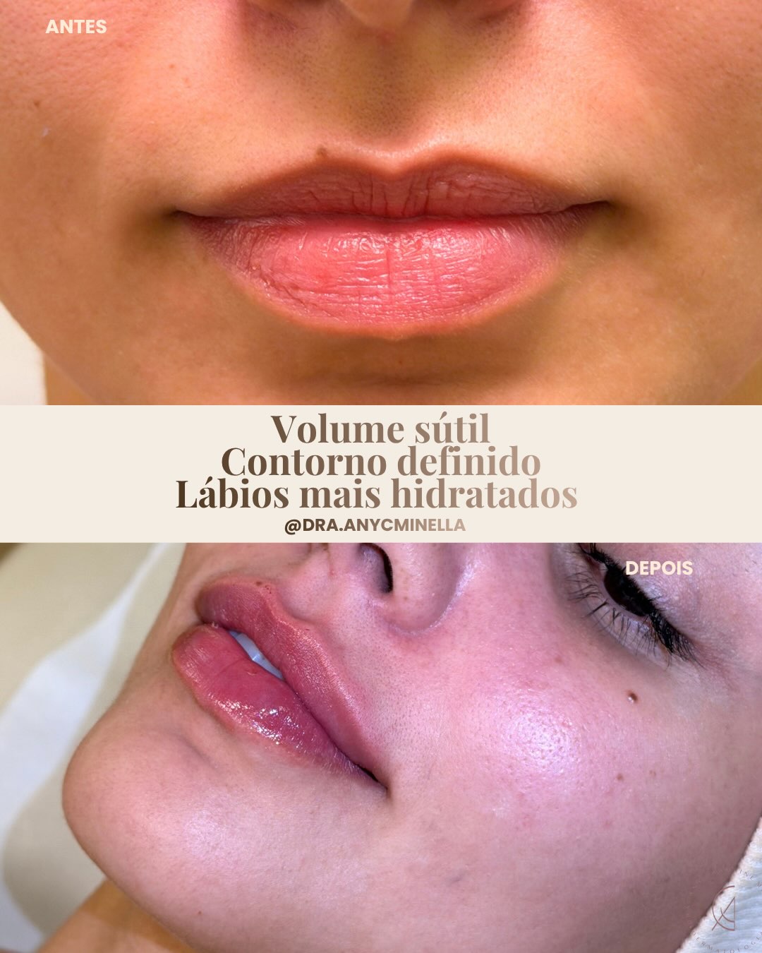 Um caso de cuidado labial. Registro original publicado no Instagram da Dra. Any